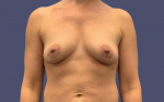 Breast Lift w/Fat Transfer 2 After